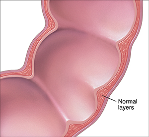 Cross section of colon showing the normal layers of intestine wall.