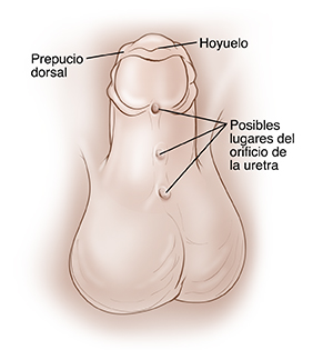 Pene de un niño que apunta hacia arriba para mostrar la parte de abajo. El prepucio que rodea el glande forma una especie de capucha que cubre la punta del pene. Depresión en la punta del pene. Tres orificios a lo largo de la parte inferior central del pene, desde el glande hasta el escroto, muestran los posibles lugares donde puede estar la abertura de la uretra.