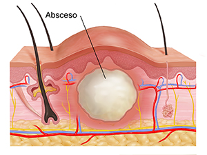 Corte transversal de las capas de la piel que muestra un absceso.