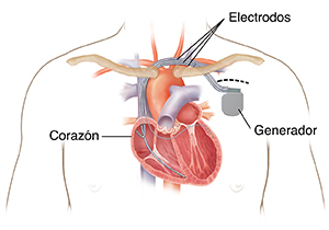 Contorno del pecho de un hombre en el que puede verse un marcapasos y DAI biventricular colocado con tres cables que van hacia las cámaras del corazón.